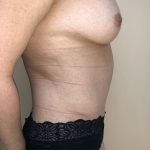 Tummy Tuck Before & After Patient #6341