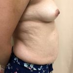 Tummy Tuck Before & After Patient #6341