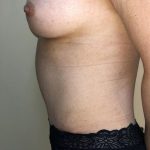 Tummy Tuck Before & After Patient #6341