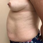 Tummy Tuck Before & After Patient #6341