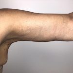 Post Bariatric Body Contouring Before & After Patient #6336