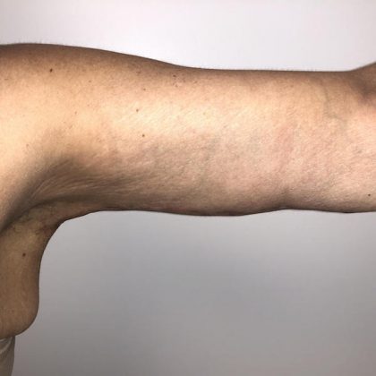 Post Bariatric Body Contouring Before & After Patient #6336