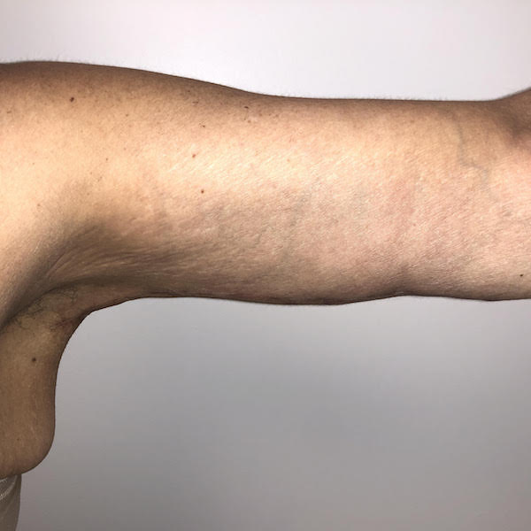 Post Bariatric Body Contouring Before & After Patient #6336