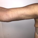 Post Bariatric Body Contouring Before & After Patient #6336