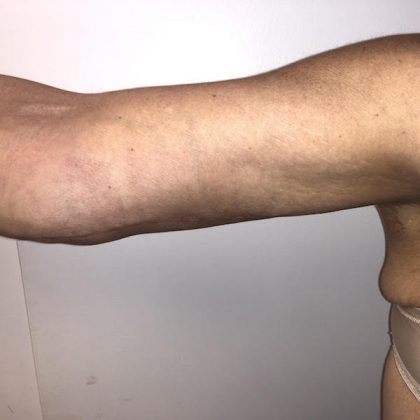 Post Bariatric Body Contouring Before & After Patient #6336