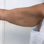 Post Bariatric Body Contouring Before & After Patient #6336