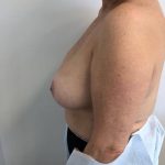 Breast Reconstruction Before & After Patient #6362
