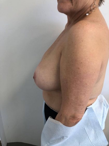 Breast Reconstruction Before & After Patient #6362