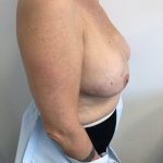 Breast Reconstruction Before & After Patient #6362
