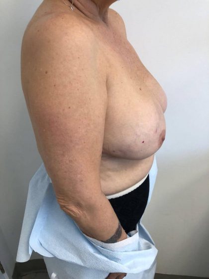 Breast Reconstruction Before & After Patient #6362