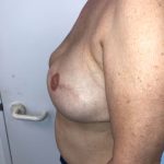 Breast Reconstruction Before & After Patient #6362