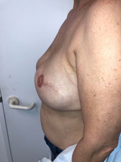 Breast Reconstruction Before & After Patient #6362
