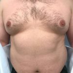Gynecomastia Before & After Patient #6408