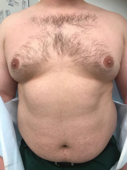 Gynecomastia Before & After Patient #6408