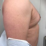 Gynecomastia Before & After Patient #6408