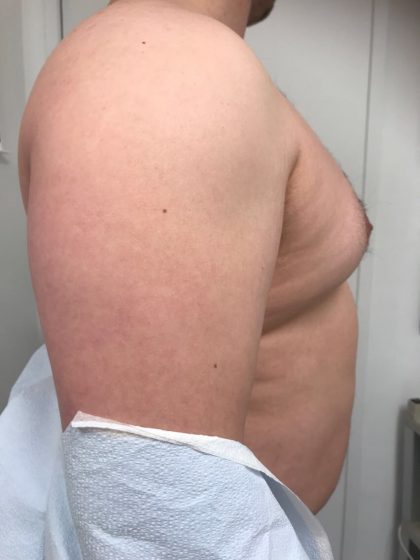 Gynecomastia Before & After Patient #6408