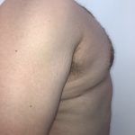 Gynecomastia Before & After Patient #6408