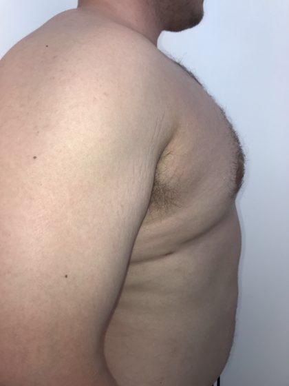 Gynecomastia Before & After Patient #6408