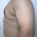 Gynecomastia Before & After Patient #6408