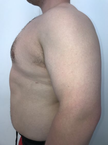 Gynecomastia Before & After Patient #6408