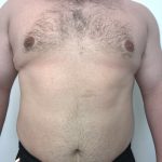 Gynecomastia Before & After Patient #6408