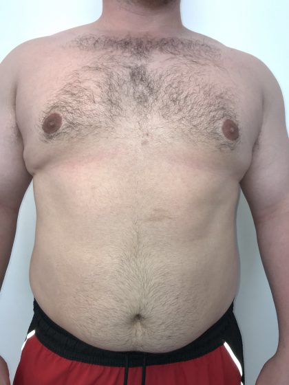 Gynecomastia Before & After Patient #6408