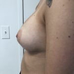 Breast Augmentation Before & After Patient #6416