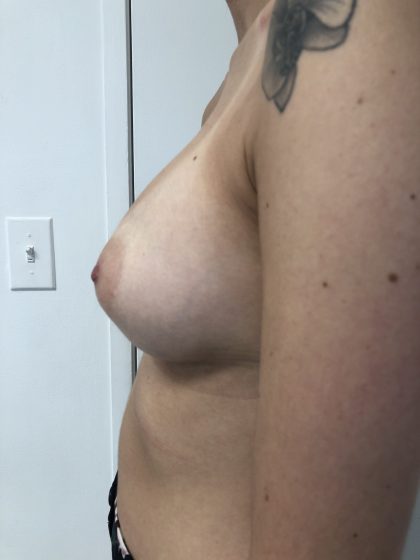 Breast Augmentation Before & After Patient #6416