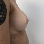 Breast Augmentation Before & After Patient #6416