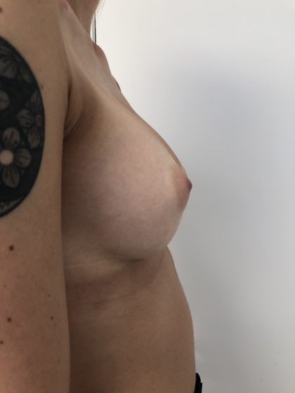 Breast Augmentation Before & After Patient #6416