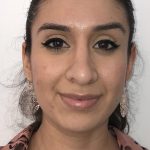 Rhinoplasty Before & After Patient #6394