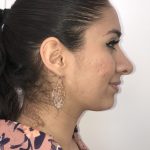 Rhinoplasty Before & After Patient #6394