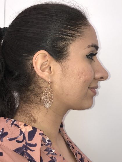 Rhinoplasty Before & After Patient #6394