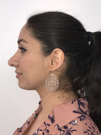 Rhinoplasty Before & After Patient #6394