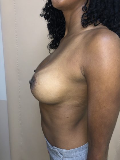 Breast Augmentation Before & After Patient #6401