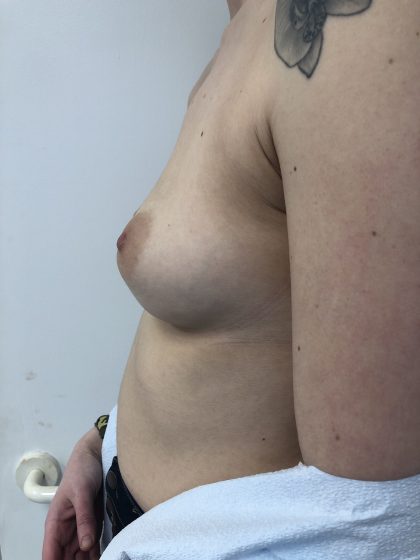 Breast Augmentation Before & After Patient #6416