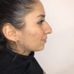 Rhinoplasty Before & After Patient #6394