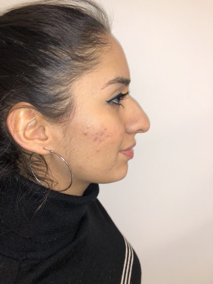 Rhinoplasty Before & After Patient #6394
