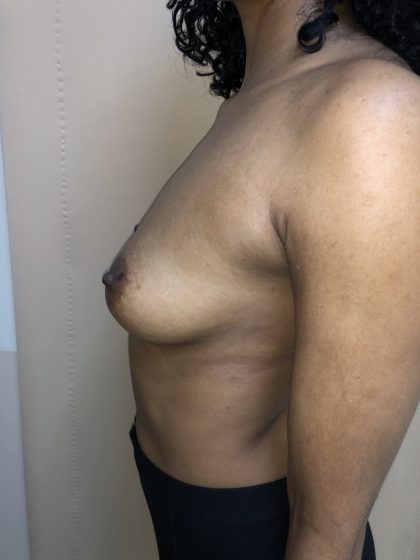 Breast Augmentation Before & After Patient #6401