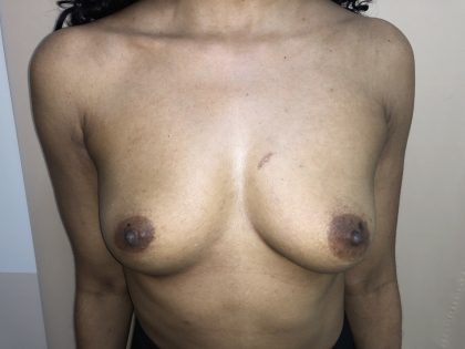 Breast Augmentation Before & After Patient #6401