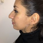 Rhinoplasty Before & After Patient #6394
