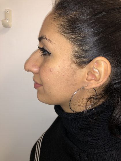 Rhinoplasty Before & After Patient #6394