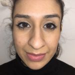 Rhinoplasty Before & After Patient #6394