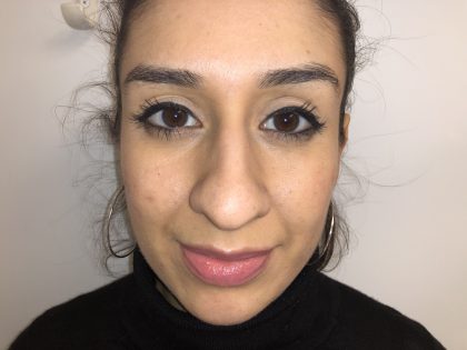 Rhinoplasty Before & After Patient #6394