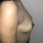 Breast Augmentation Before & After Patient #6401