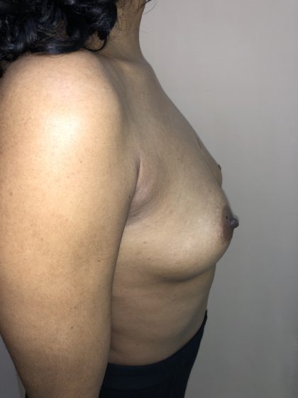 Breast Augmentation Before & After Patient #6401
