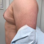 Gynecomastia Before & After Patient #6408