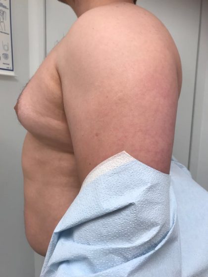 Gynecomastia Before & After Patient #6408