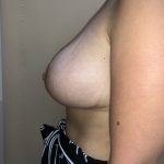 Breast Augmentation Before & After Patient #6496