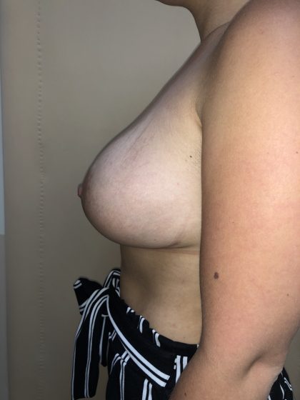 Breast Augmentation Before & After Patient #6496
